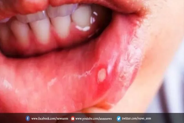 ऐसे मिलेगी मुंह के छालों से राहत