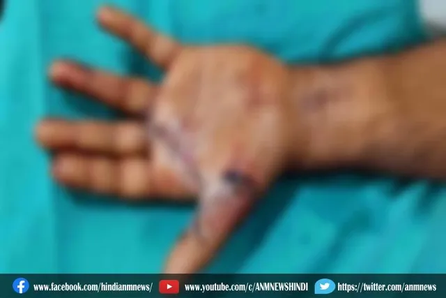 दुबई में कटा अंगूठा, दिल्ली में डॉक्टरों ने जोड़ा