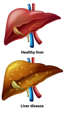 Fatty Liver को प्राकृतिक रूप से ठीक कैसे करें?