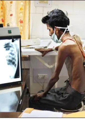 அதிக காசநோய் பாதிப்பில் இந்தியா!