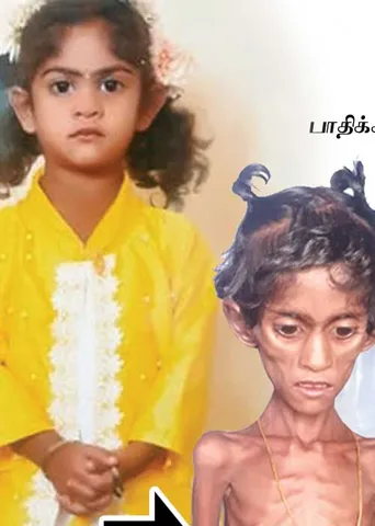 தின்பண்டமான கினீனிங் பவுடர்! சிறுமியின் உயிர்ப் போராட்டம்!