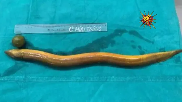 WTF ! Man Inserts Live Eel into Rectum, Requires Emergency Surgery in Vietnam