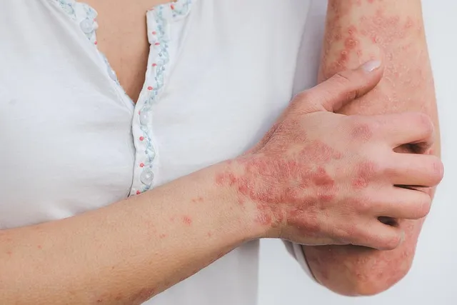 Study shows why psoriasis patients may be at risk of obesity, fatty liver disease