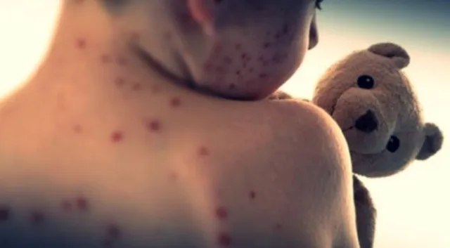Measles cases in U.S. reach highest level in over 30 years
