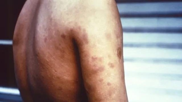 Maharashtra declares leprosy a ‘notifiable disease’