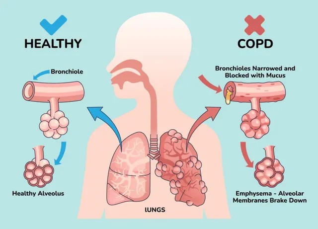 Breathe Easy: Know COPD Before It Stops You