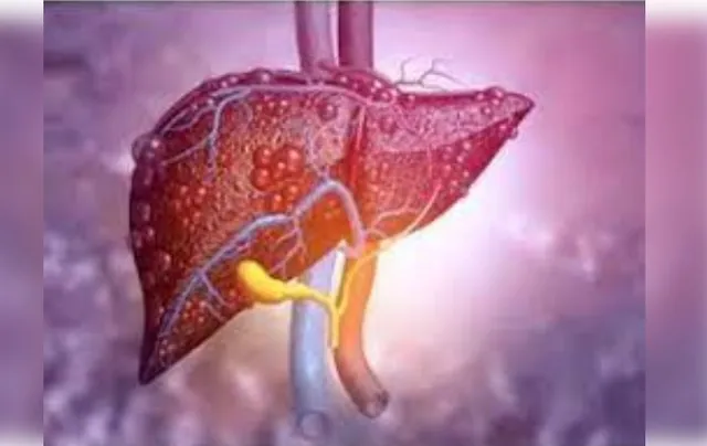 Poor sleep may worsen fatty liver disease, shows study