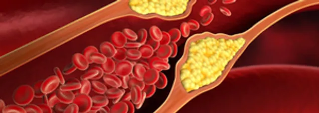 How high cholesterol, microplastics are contributing to rising heart diseases