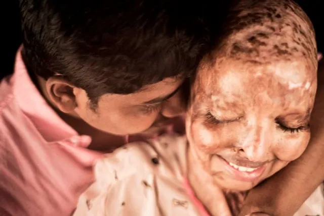 Odisha acid attack survivor Pramodini to get engaged to beau on Valentine's Day