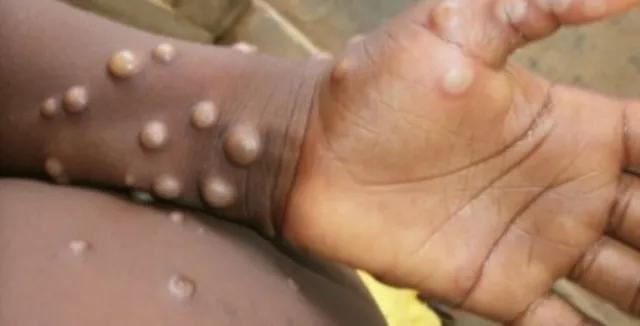 Study reveals monkeypox may persist in body for 10 weeks