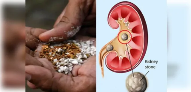Pan masala consumption can cause larger kidney stones: Experts