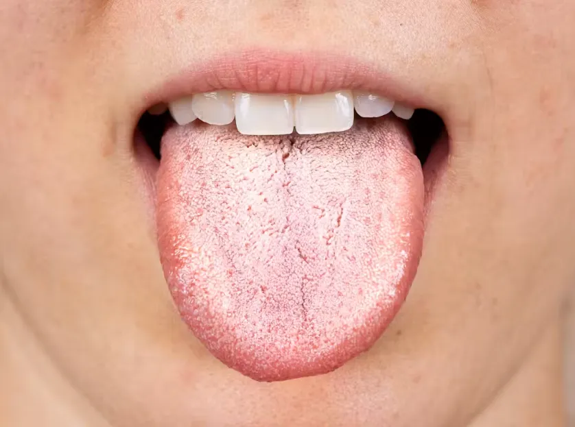 Some people taking the weight loss drug experience a bacterial buidl-up on their tongue. sruilk/ Shutterstock