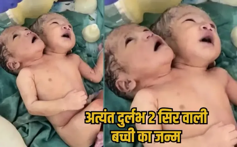 Indore 2 Head Baby: एक धड़, 2 सिर और दिल एक, इंदौर में अनोखी बच्ची का जन्म, डॉक्टर्स हैरान