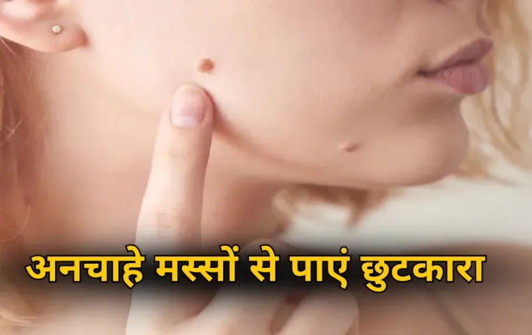 Moles Removal Tips: शरीर पर अनचाहे मस्सों से हैं परेशान? इन आसान घरेलू नुस्खों से रातों-रात पाएं छुटकारा