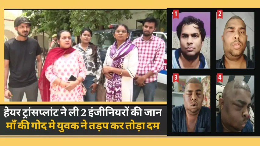 Hair Transplant Death Case: हेयर ट्रांसप्लांट के बाद एक और इंजीनियर की मौत, डॉक्टर अनुष्का तिवारी पर लापरवाही के आरोप