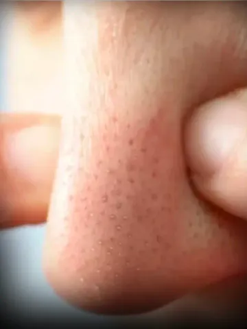 White Heads Removing Tips