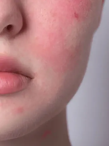 Summer Skin Redness Reasons