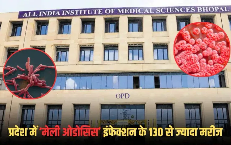 AIIMS Bhopal: एम्स भोपाल की रिपोर्ट, मप्र में तेजी से फैल रहा मेलीओडोसिस संक्रमण, लोग समझ रहे टीबी; मृत्युदर 40 फीसदी