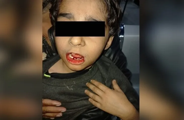 Bhopal News: कार के पास खेलने की बात पर हुआ विवाद तो मासूम को लात घूसों से पीटा, बच्ची के पिता से भी मारपीट