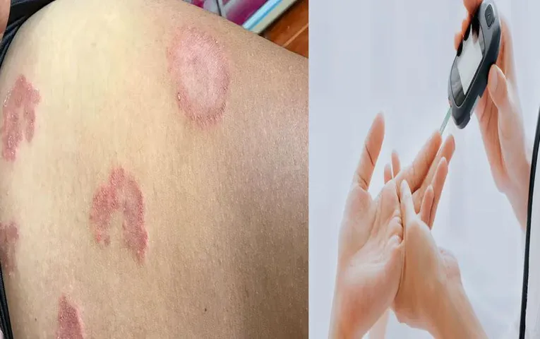 Symptoms of Diabetes: त्वचा की ये समस्याएं हल्के में ना लें, जानें ये 3 लक्षण, हो सकता है डाइबिटीज़ के संकेत