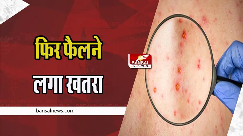 Balia Chickenpox Infection: स्कूल में 9 छात्र समेत एक शिक्षक चिकनपॉक्स की चपेट में, फिर फैलने लगा खतरा
