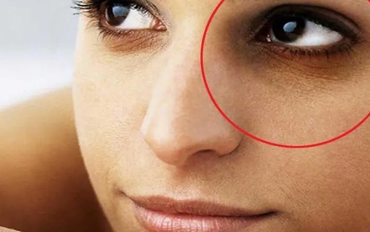 Dark Circles Home Treatment: आंखों के नीचे काले घेरे को दूर करने के लिए आज से ही आजमाएं ये घरेलू नुस्खे