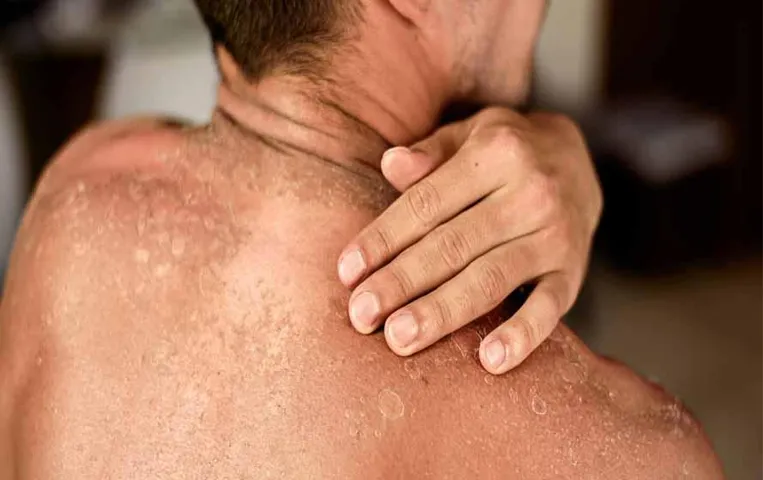 त्वचा कैंसर जांच के दिशा-निर्देश भ्रमित करने वाले जान पड़ते हैं, विशेषज्ञों नें दिए सुझाव