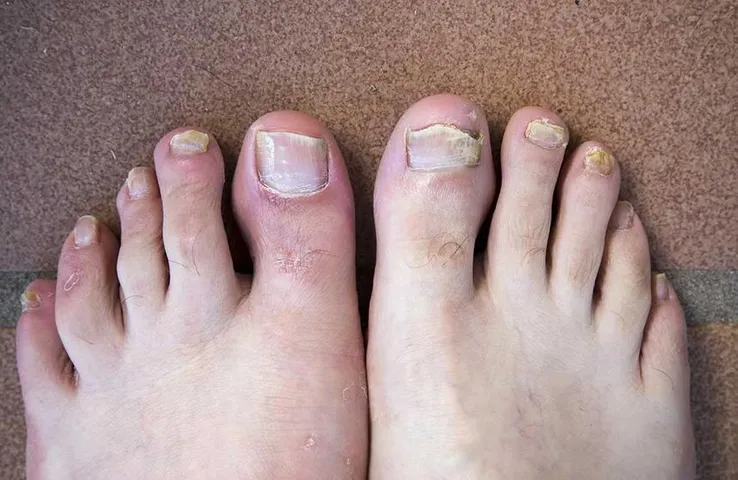 Fungal Infection In Feet: मानसून में अक्सर पैरों में क्यों होता फंगल इन्फेक्शन, जानिए कैसे करें इससे बचाव