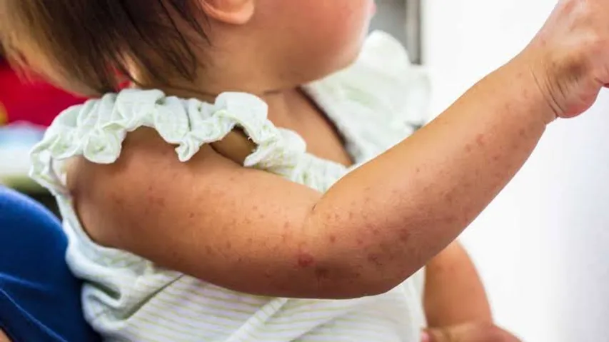 WHO Flags India as major measles hotspot