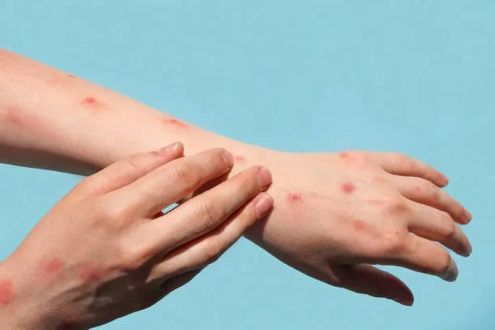 Kerala to issue New Mpox guidelines post new strain