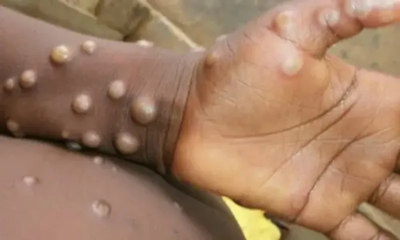 Task force formed to closely monitor monkeypox menace in India