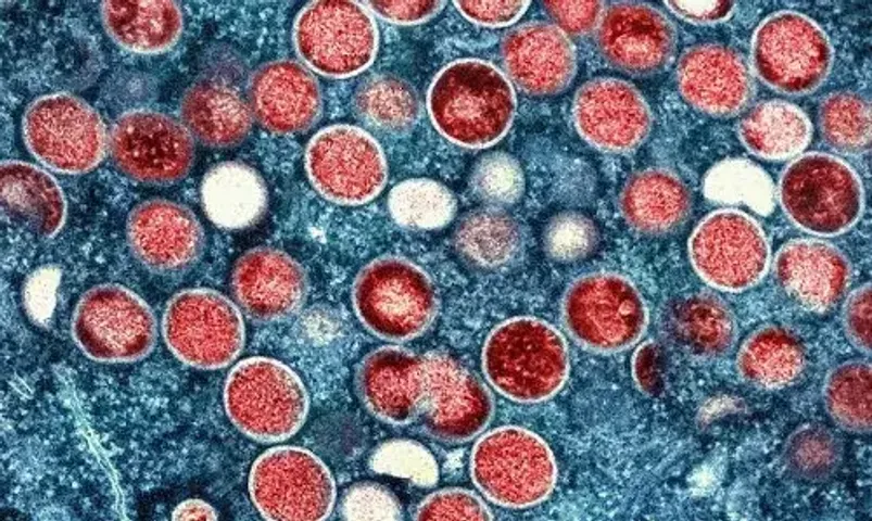 China Mpox cases surge as virus spreads to more parts of country