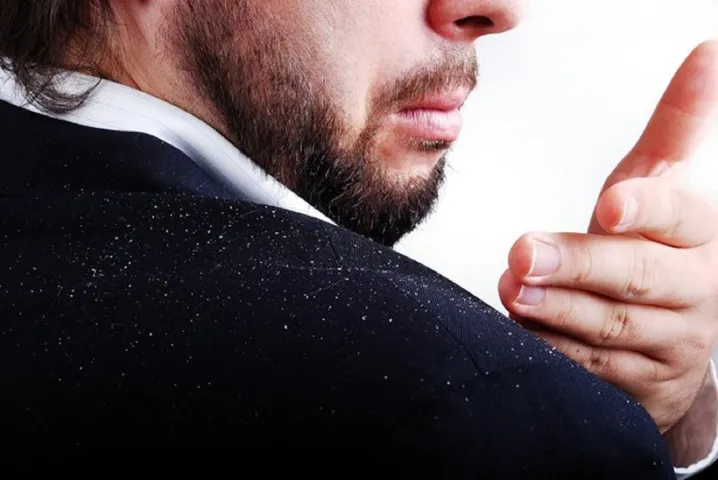 Tips to remove dandruff in a natural way