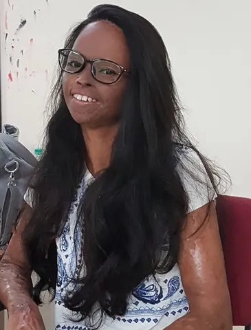 It was the darkest day in my life when the boy attacked me and threw acid on me : Laxmi Saa