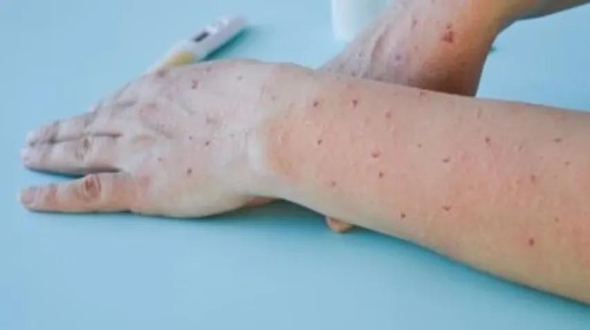 scssમોકે pox 