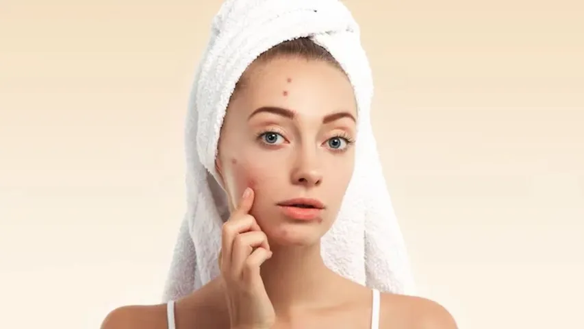 REMOVE PIMPLES