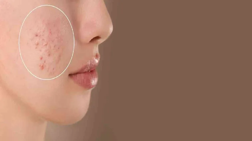 pimple