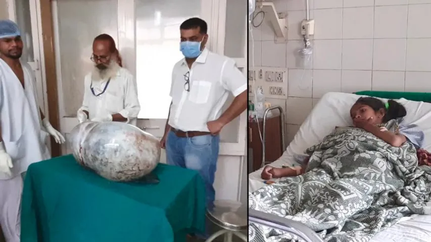 દાહોદ : 14 વર્ષની કિશોરીના પેટમાંથી તબીબોએ ઓપરેશન કરી 20 કિલોની ગાંઠ કાઢી