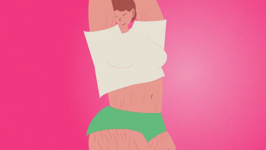 An illustration of a woman with stretch marks on her arms and thighs