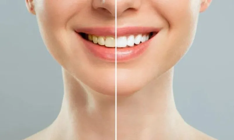 To Get Rid Of Yellowing Of Teeth, Follow These 5 Home Remedies