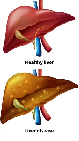 Foods to reduce liver fat