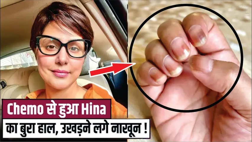 Hina Khan's Nails Got Dried Due To Chemotherapy | Hina khan suffering from chemotherapy side effects
