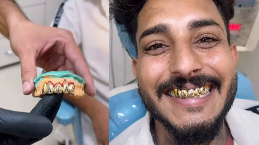 VIDEO: ಹಲ್ಲು ಕೀಳಿಸಿ ಚಿನ್ನದ ಹಲ್ಲು ಹಾಕಿಸಿಕೊಂಡ ಭೂಪ; ಭಾರತದಲ್ಲಿ ಈ ರೀತಿ ಇರೋದು ಇವನೊಬ್ಬನೇ!