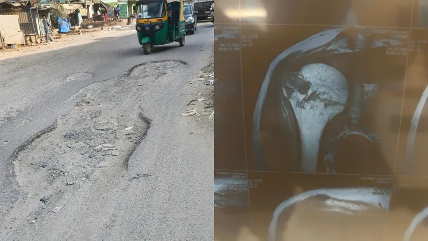 PERSON INJURED DUE TO POTHOLE