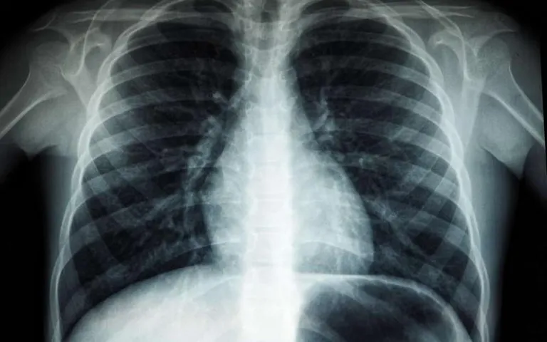 AI can predict age with chest X-Ray sample