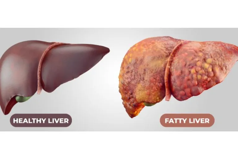 Simple steps to keep Non-alcoholic Fatty Liver Disease at bay