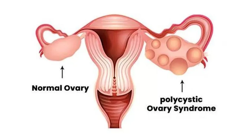 PCOS