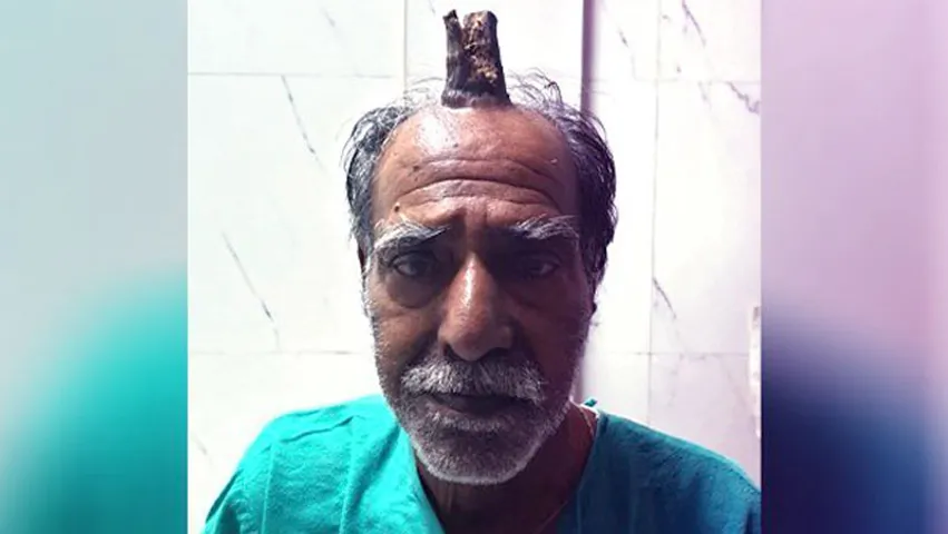 ବୃଦ୍ଧଙ୍କ ମୁଣ୍ଡରେ ଶିଙ୍ଗ