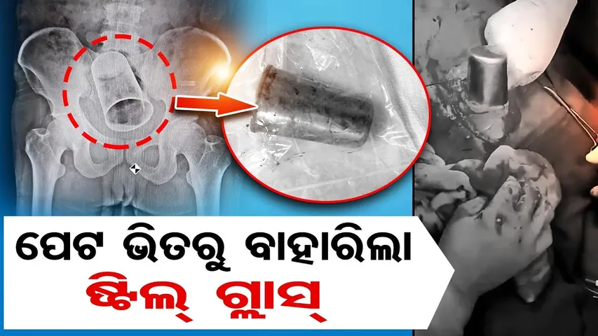 ବ୍ୟକ୍ତିଙ୍କ ପେଟରୁ ବାହାରିଲା ଗ୍ଲାସ