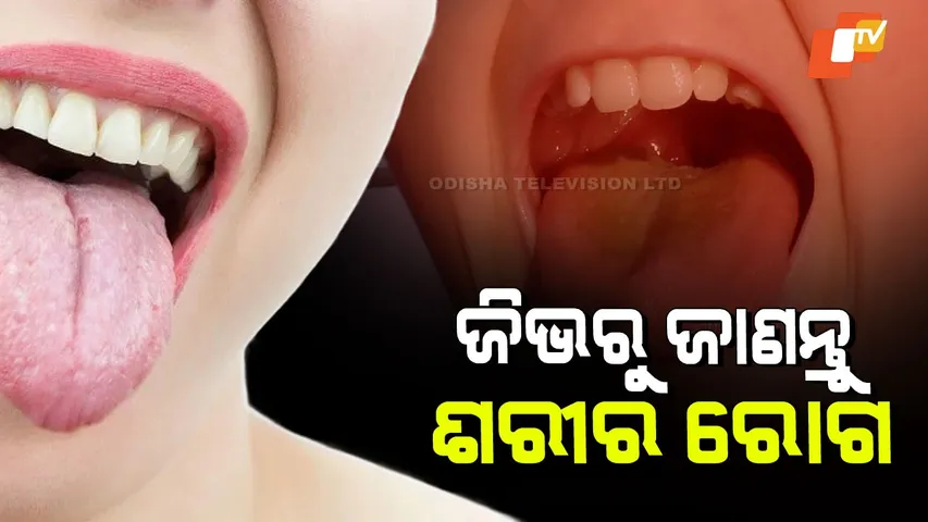 White or Yellow Tongue Coating